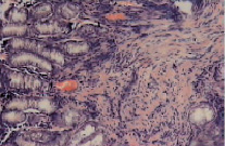Гистологическая картина язвы желудка thumbnail